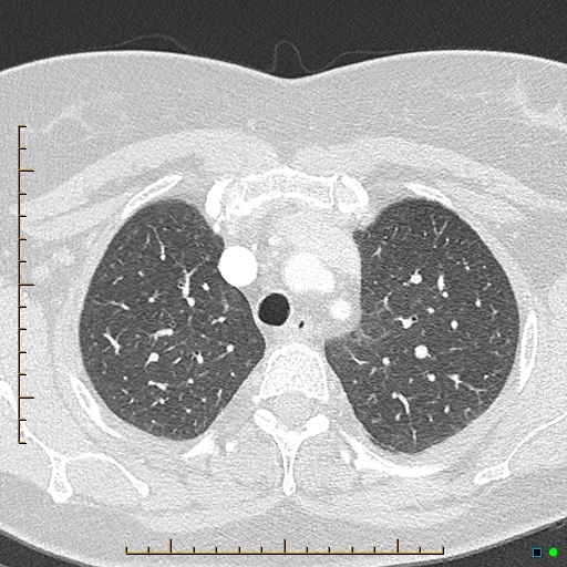 Bronchial diverticula (Radiopaedia 79512-92676 Axial lung window 36).jpg
