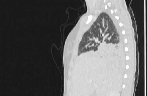 Bronchial mucoepidermoid carcinoma (Radiopaedia 57023-63895 Sagittal lung window 28).jpg