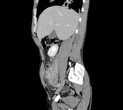 File:Bronchiectasis in Crohn disease (Radiopaedia 60311-67977 D 34).jpg