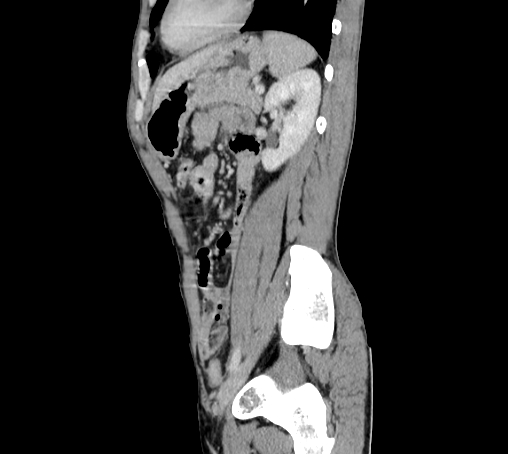 Bronchiectasis in Crohn disease (Radiopaedia 60311-67977 D 81).jpg
