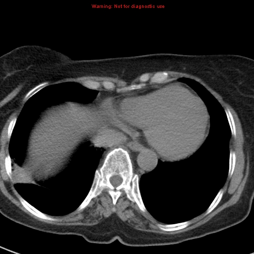 File:Bronchoalveolar carcinoma (BAC) (Radiopaedia 13436-13392 Axial non-contrast 39).jpg