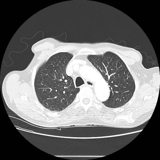 Bronchocele (Radiopaedia 17097-16795 Axial lung window 33).jpg