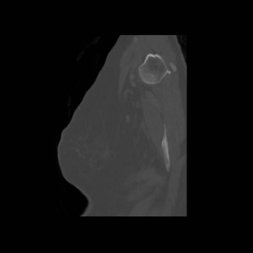 Bronchogenic carcinoma (Radiopaedia 73497-84262 Sagittal bone window 145).jpg