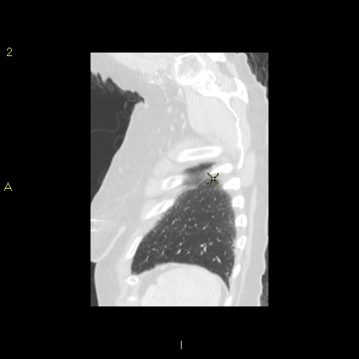 File:Bronchogenic carcinoma as an incidental finding (Radiopaedia 16453-16130 Sagittal lung window 8).jpg