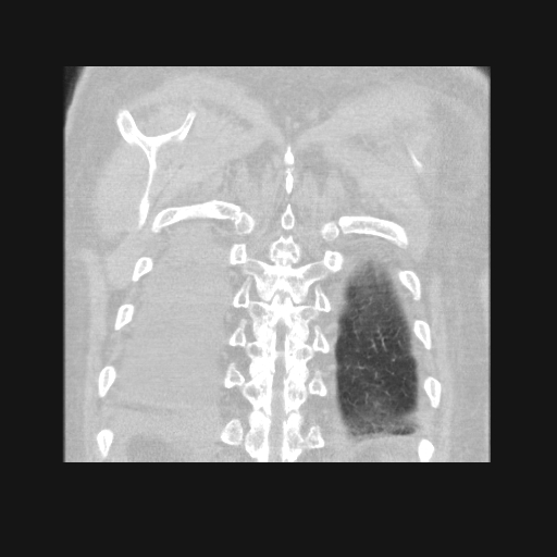 File:Bronchogenic carcinoma with metastatic lymphadenopathy (Radiopaedia 37671-39569 Coronal lung window 42).jpg