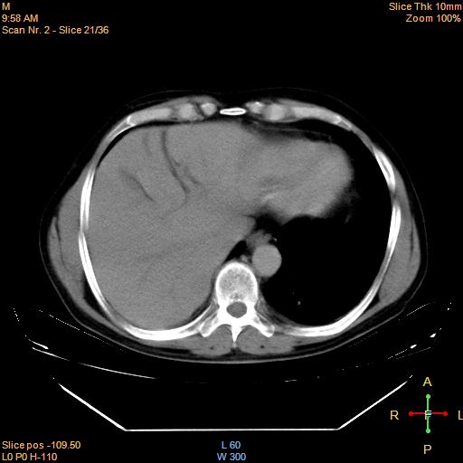 File:Bronchogenic carcinoma with superior vena caval invasion (Radiopaedia 22378-22406 Axial liver window 18).jpg