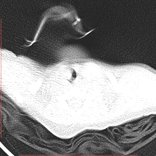Bronchogenic cyst (Radiopaedia 78599-91409 Axial lung window 7).jpg
