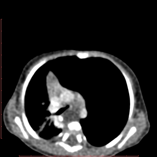 Bronchogenic cyst (Radiopaedia 78599-91409 B 87).jpg