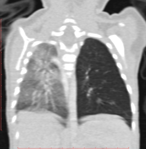 Bronchogenic cyst (Radiopaedia 78599-91409 Coronal lung window 158).jpg