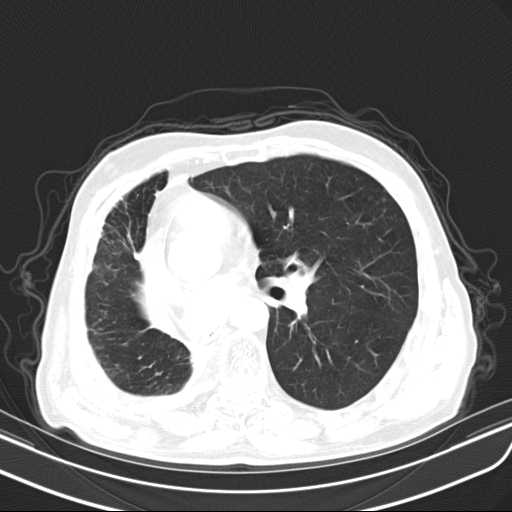 File:Bronchopleural fistula - postoperative complication (Radiopaedia 21020-20947 Axial lung window 29).jpg