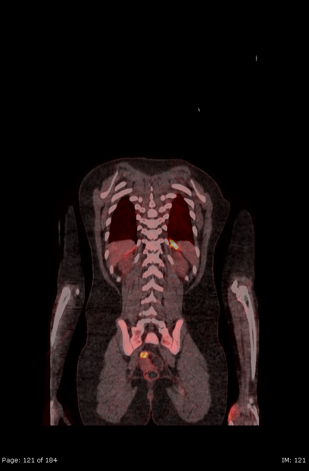 Brown fat uptake (FDG PET-CT) (Radiopaedia 77392-89513 Fused coronal 79).jpg
