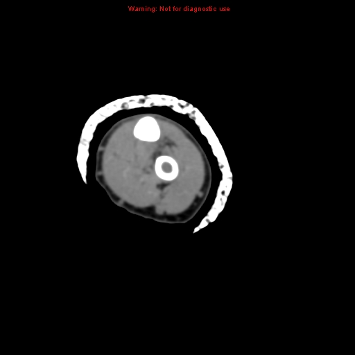 Brown tumor (Radiopaedia 12460-12694 Axial non-contrast 103).jpg