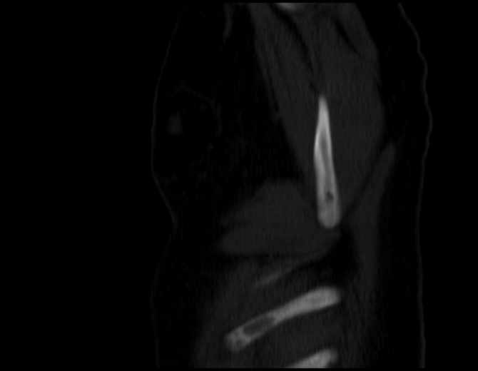 Brown tumors compressing the spinal cord (Radiopaedia 68442-77988 Sagittal bone window 55).jpg