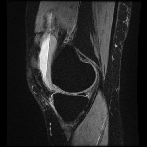 Bucket handle meniscus tear (Radiopaedia 56916-63751 H 60).jpg