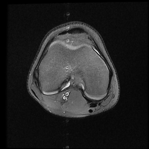 File:Bucket handle tear - lateral meniscus (Radiopaedia 72124-82634 Axial PD fat sat 7).jpg