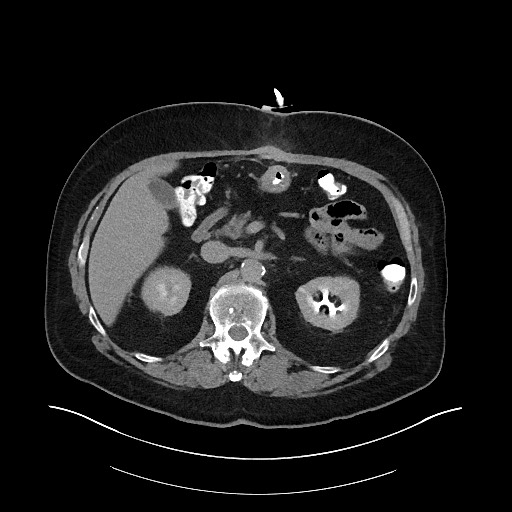 File:Buried bumper syndrome - gastrostomy tube (Radiopaedia 63843-72575 Axial 78).jpg