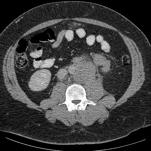 Burned-out testicular seminoma - retroperitoneal nodal metastases (Radiopaedia 62872-71245 A 40).jpg