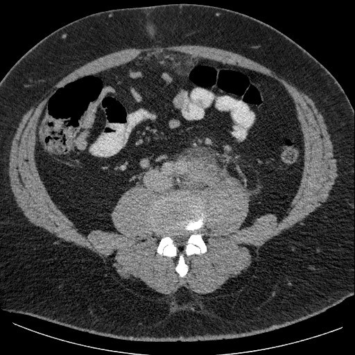 Burned-out testicular seminoma - retroperitoneal nodal metastases (Radiopaedia 62872-71245 A 44).jpg