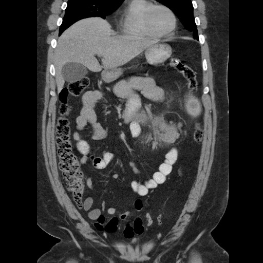 File:Burned-out testicular seminoma - retroperitoneal nodal metastases (Radiopaedia 62872-71245 B 24).jpg