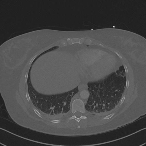 File:Burst fracture - thoracic spine (Radiopaedia 30238-30865 Axial bone window 66).jpg