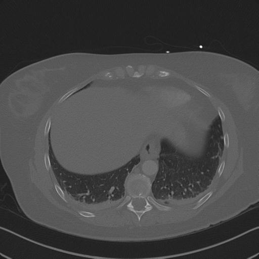 Burst fracture - thoracic spine (Radiopaedia 30238-30865 Axial bone window 69).jpg