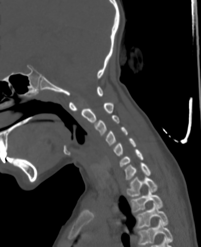 Butterfly vertebra (Radiopaedia 77903-90209 Sagittal bone window 32).jpg