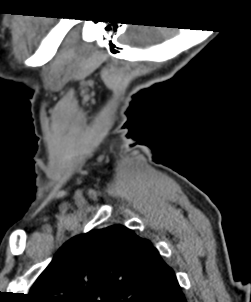 C2 fracture with vertebral artery dissection (Radiopaedia 37378-39199 D 10).png