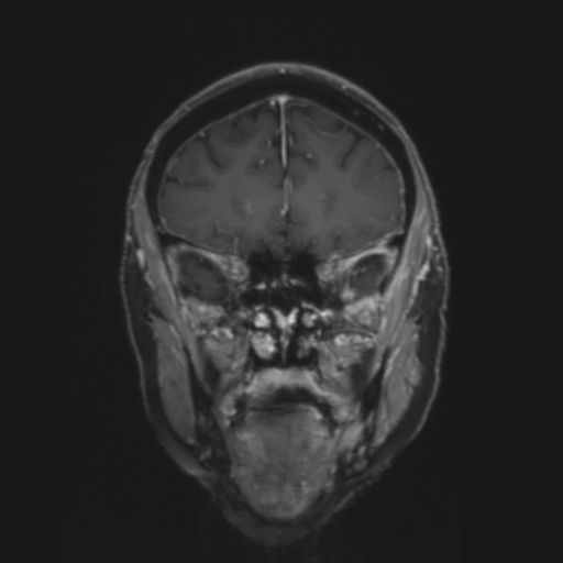 File:CNS lymphoma with steroid response (Radiopaedia 37980-39921 Coronal T1 C+ 10).png