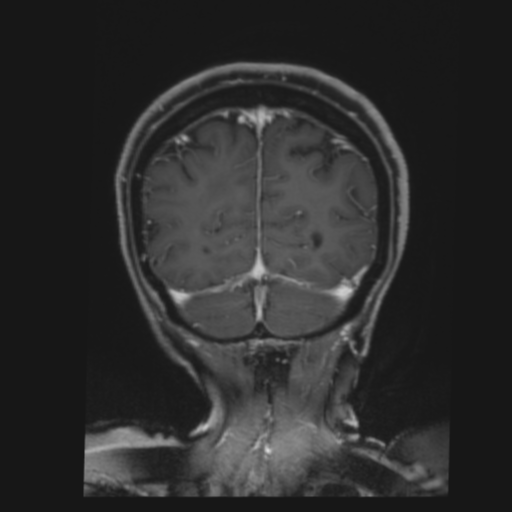 CNS lymphoma with steroid response (Radiopaedia 37980-39921 Coronal T1 C+ 41).png