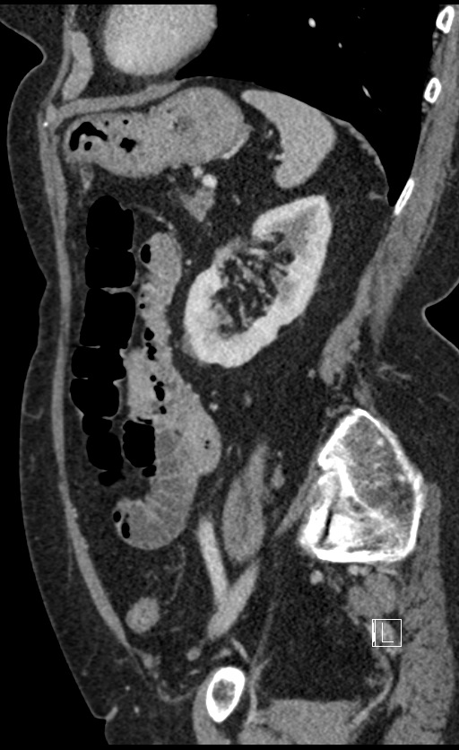Calcified adrenal glands and Spigelian hernia (Radiopaedia 49741-54988 C 48).jpg
