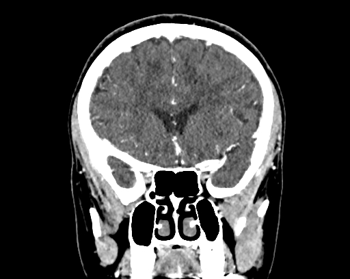 Calcified cerebral hydatid cyst (Radiopaedia 65603-74717 C 22).jpg