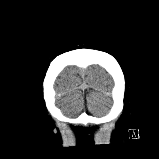 File:Calcified chronic subdural hematoma (Radiopaedia 77374-89492 Coronal non-contrast 47).jpg