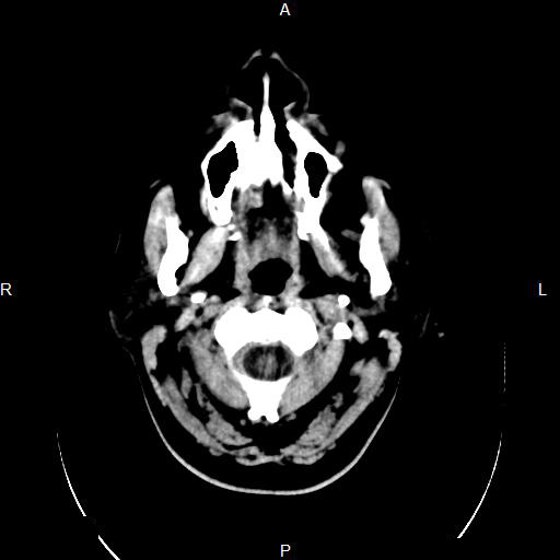 File:Calcified intracranial tuberculoma (Radiopaedia 9657).jpg