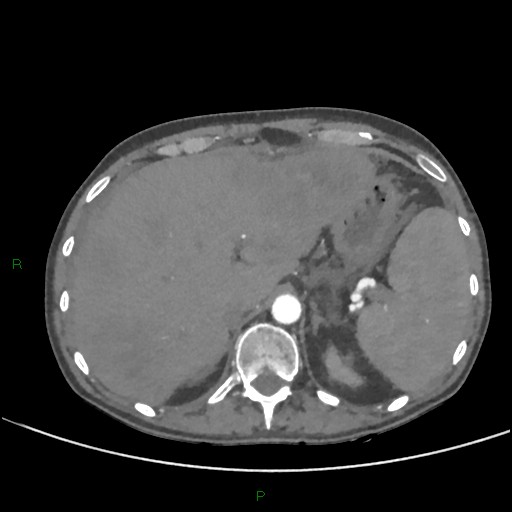 Cannonball metastases (Radiopaedia 82110-96150 Axial C+ CTPA 318).jpg