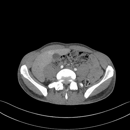 File:Cannonball metastases - testicular choriocarcinoma (Radiopaedia 84510-99891 B 154).jpg