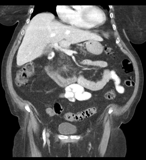 File:Cannonball metastases from endometrial cancer (Radiopaedia 42003-45031 F 30).png