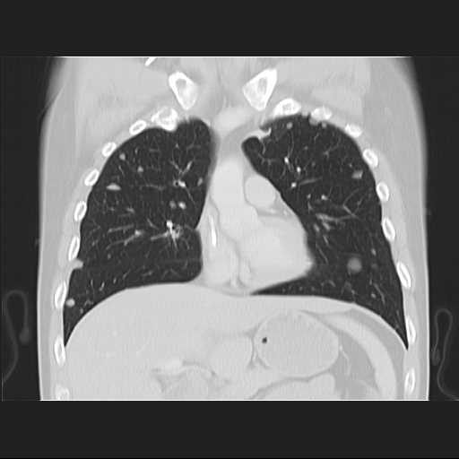 File:Cannonball pulmonary metastases (Radiopaedia 67684-77101 C 9).jpg
