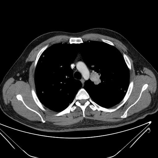 File:Cannonball pulmonary metastases (Radiopaedia 67684-77101 D 90).jpg