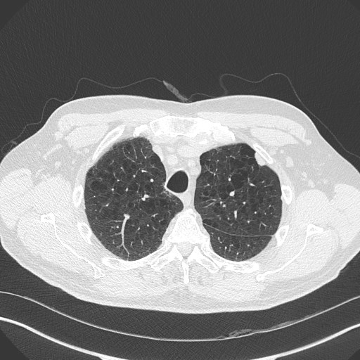 Caplan syndrome (Radiopaedia 56667-63530 Axial lung window 50).jpg