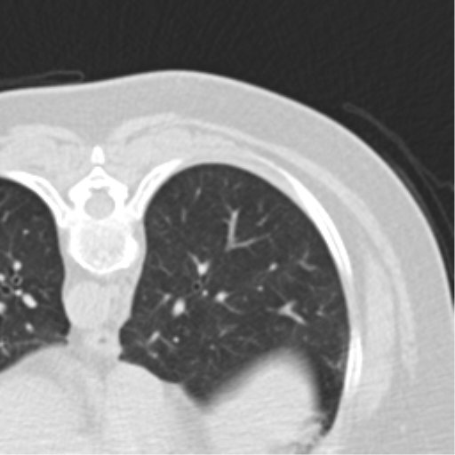 Carcinoid tumor - lung (Radiopaedia 44814-48644 Axial lung window 54).png