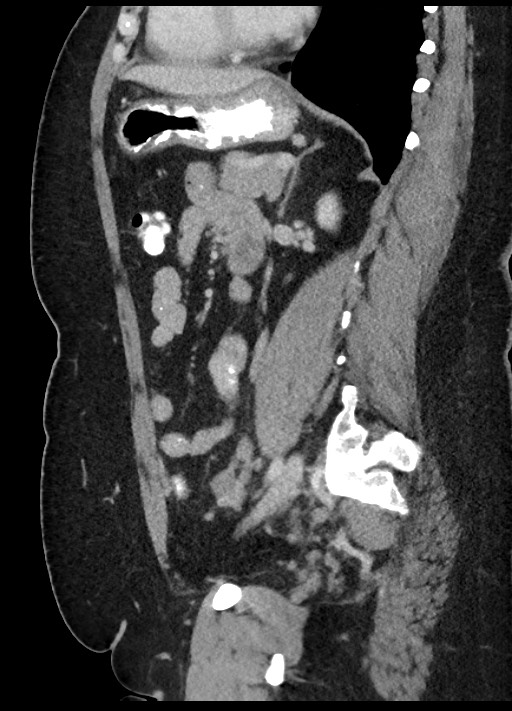 Carcinoid tumor - terminal ileum (Radiopaedia 60931-68739 C 34).jpg
