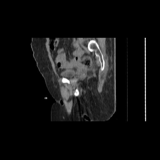 File:Carcinoma cervix- brachytherapy applicator (Radiopaedia 33135-34173 D 58).jpg