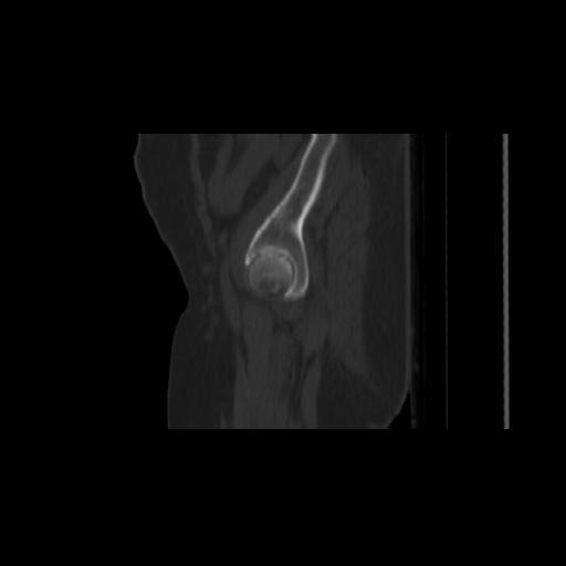 File:Carcinoma cervix- brachytherapy applicator (Radiopaedia 33135-34173 Sagittal bone window 12).jpg