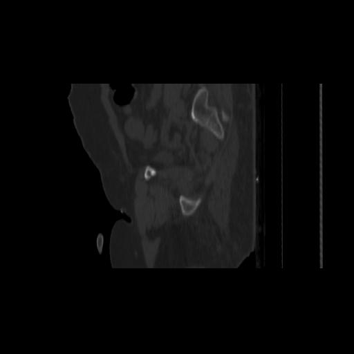 Carcinoma cervix- brachytherapy applicator (Radiopaedia 33135-34173 Sagittal bone window 139).jpg