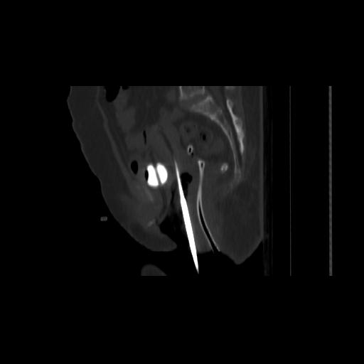 Carcinoma cervix- brachytherapy applicator (Radiopaedia 33135-34173 Sagittal bone window 90).jpg
