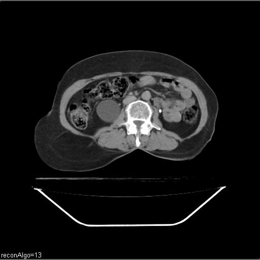 Carcinoma cervix- recurrence (Radiopaedia 34702-36137 B 78).jpg