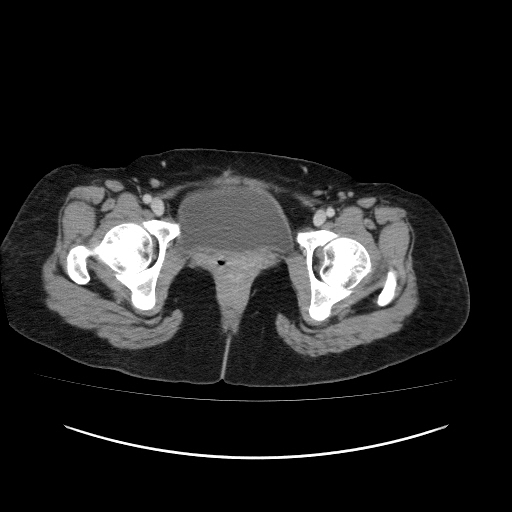 Carcinoma colon - hepatic flexure (Radiopaedia 19461-19493 A 125).jpg