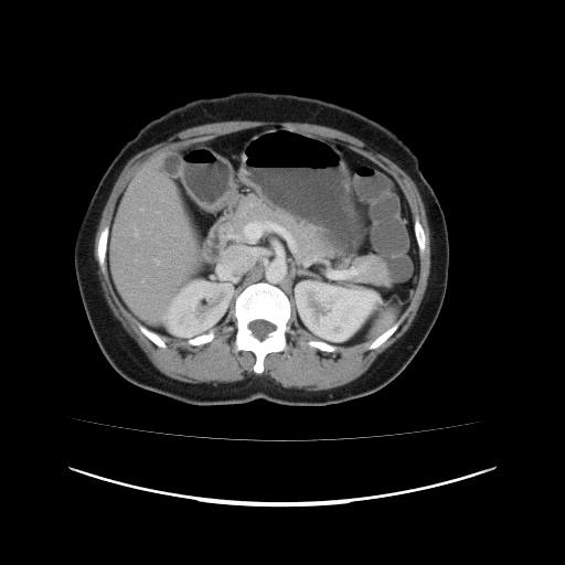 File:Carcinoma colon - hepatic flexure (Radiopaedia 19461-19493 A 43).jpg