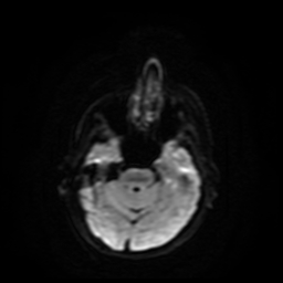 Carcinoma ex-pleomorphic adenoma of parotid (Radiopaedia 28383-28627 Ax DWI B-500 GE 65).jpg