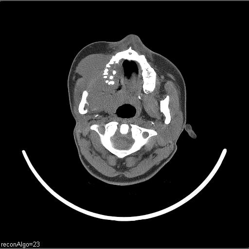 Carcinoma of the maxillary antrum (Radiopaedia 53805-59888 Axial non-contrast 52).jpg